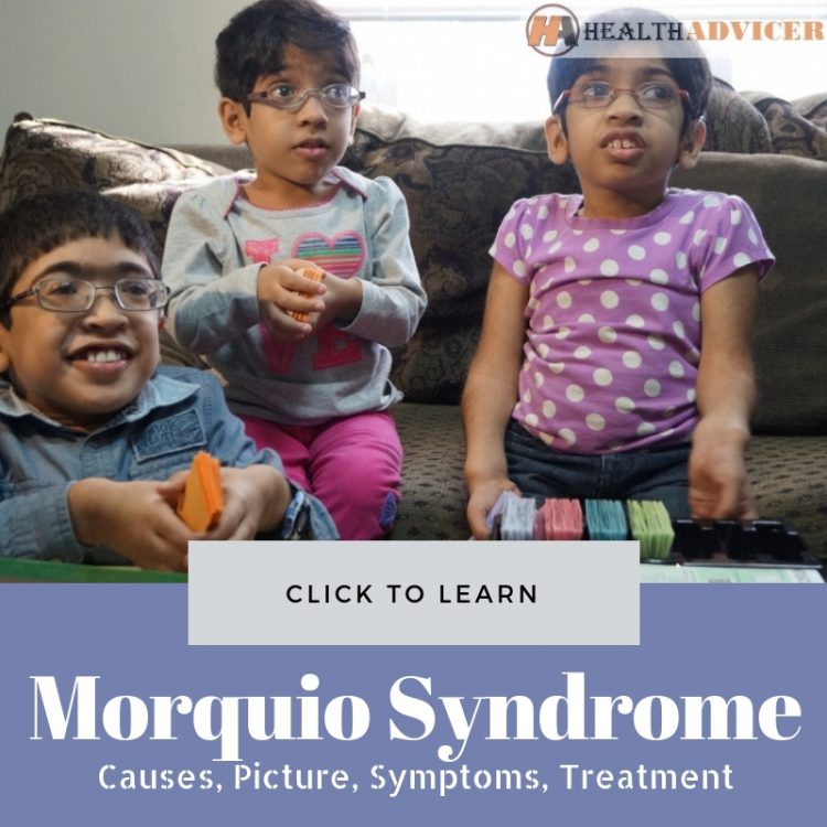 Morquio Syndrome: Causes, Picture, Symptoms And Treatment