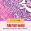 Adenomyosis