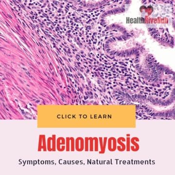 Adenomyosis