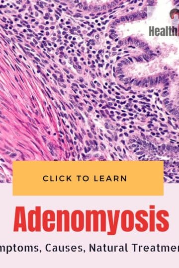 Adenomyosis