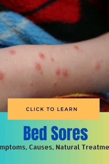 Bed Sores