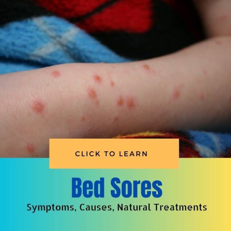 Bed Sores