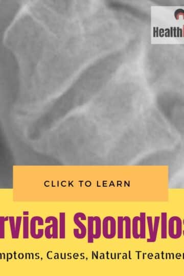 Cervical Spondylosis