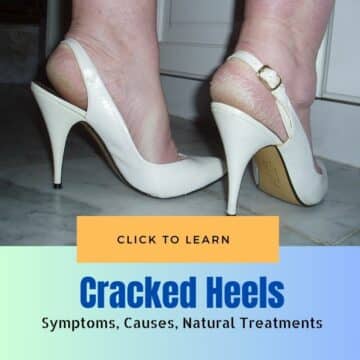 Cracked Heels