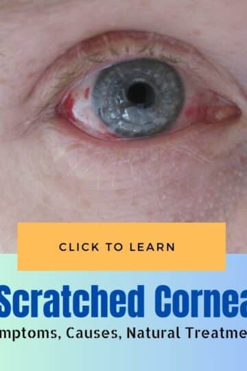 Scratched Cornea