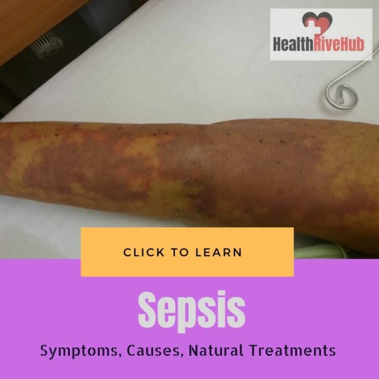 Sepsis